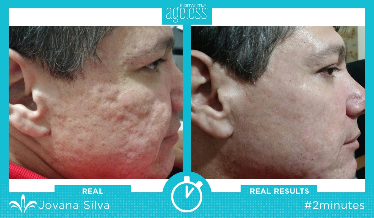 Instantly Ageless Before and After Photos